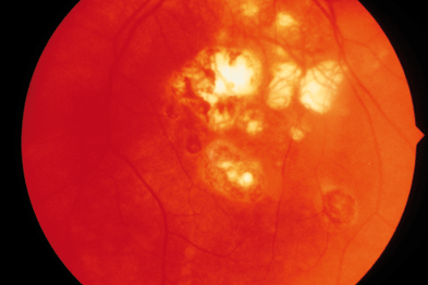 Toxoplasmosis causes scarring of the retina (yellow lesions) (Photograph: SPL)