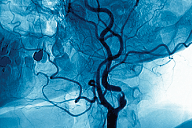 Significant carotid stenosis should be treated with endarterectomy (Photograph: SPL)