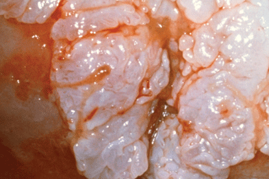 papilomul cervical uman