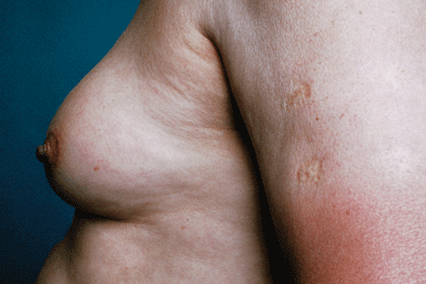 Gynaecomastia can occur at any age and can be physiological or pathological (Photograph: SPL)