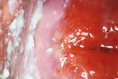 Vulvovaginal candidiasis is caused by Candida albicans (Photograph: SPL)