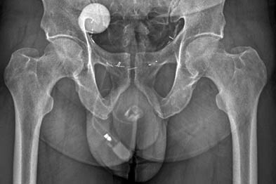 Treatment for stress incontinence may include an artificial sphincter (Photograph: SPL)
