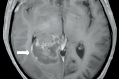 T1 MRI showing tumour