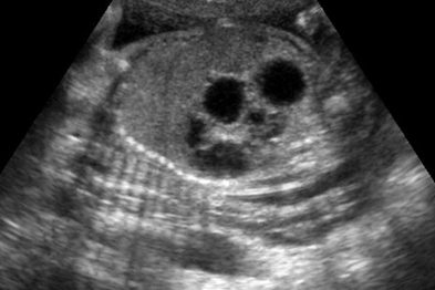 Fetal disorders, such as duodenal atresial (shown above), are associated with polyhydramnios (Photograph: SPL)