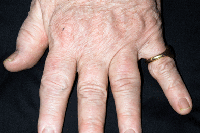 Psoriatic arthritis  (Photograph: SPL)