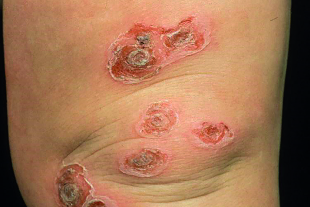 Bullous impetigo may be the cause of suspicious skin marks (Photo: Heart of England NHS Foundation Trust)