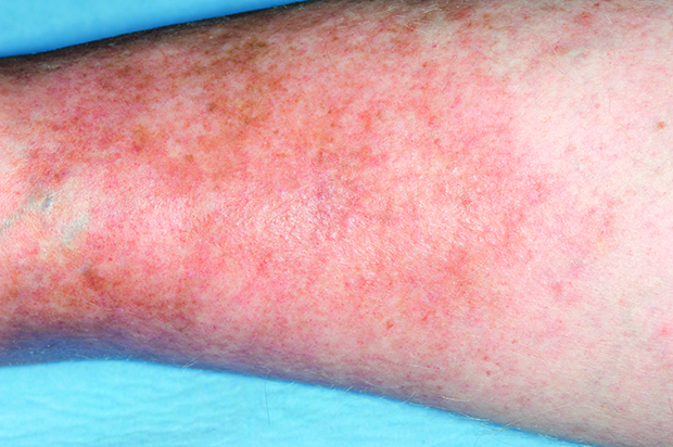 Varicoza cu eczema Varicoză / eczemă