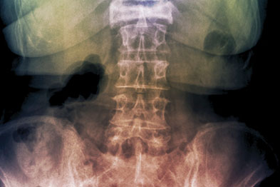 Spinal fracture: study found that HRT offered no long term protection