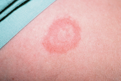 The classic erythema migrans rash is diagnostic of Lyme disease