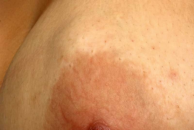 Cancerous breast lumps