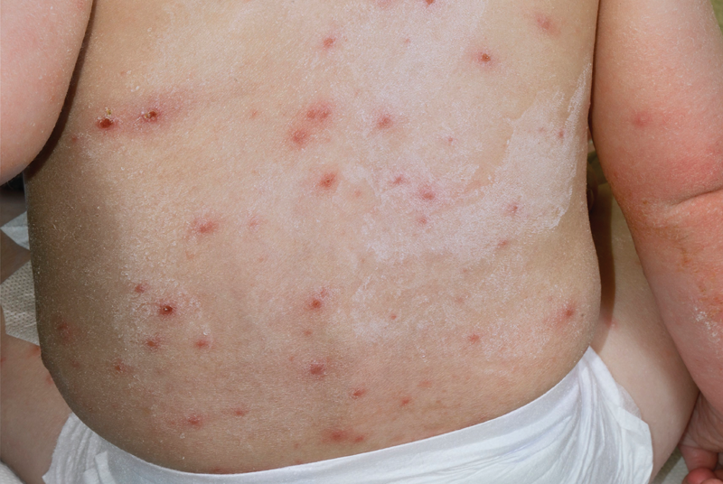 Pox symptoms chicken Chickenpox: Signs,