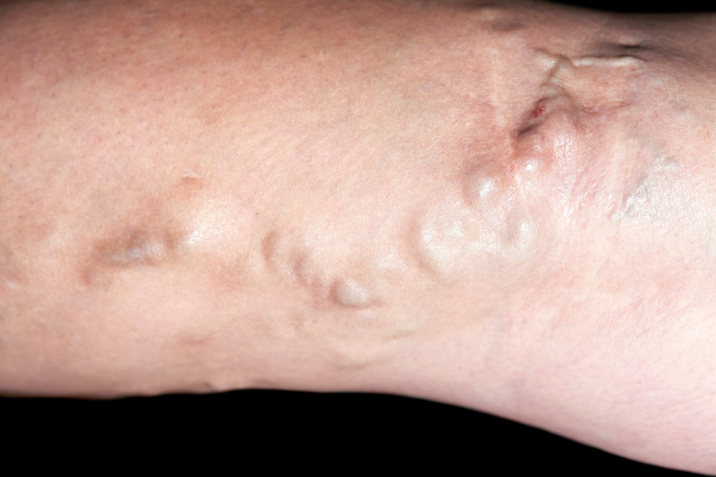 varicose botfort recenzii edema picioare varicoză medicină