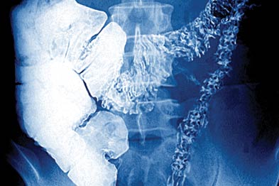 Barium enema X-ray of the abdomen showing UC in the large intestine (Photograph: SPL)