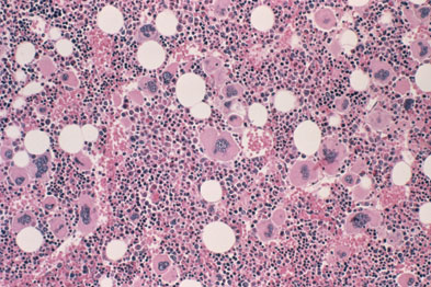 Haematology - Myelofibrosis | Gponline