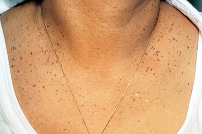 The patient had a number of small, brown papules on her chest 
