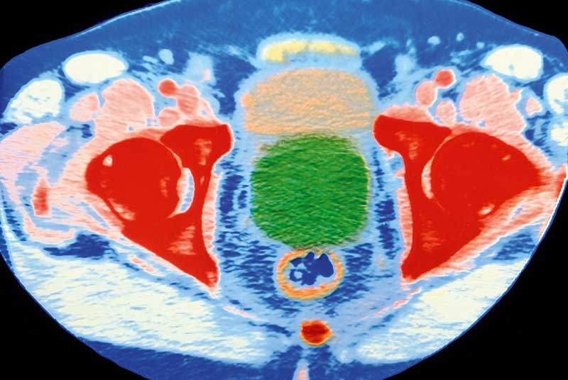 Clinical review Prostate cancer