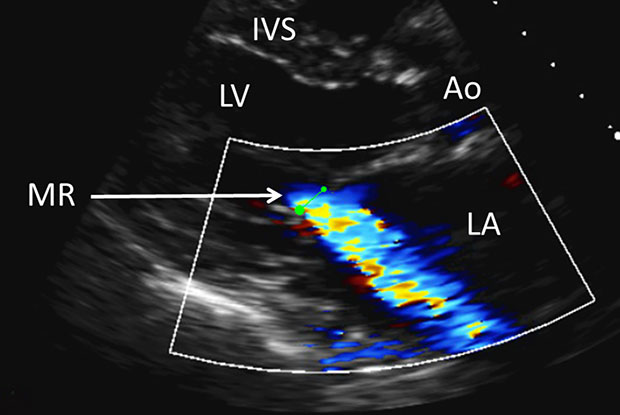 Transthoracic echocardiogram showing mitral regurgitation (‘parasternal long axis view’). RV = right ventricle. IVS = interventricular septum. LV = left ventricle. Ao = aorta. MR = mitral regurgitation. LA = left atrium.