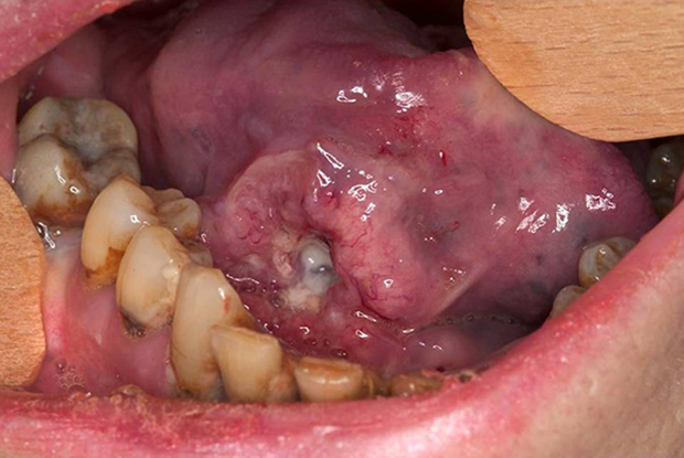 Carcinoma of the right tongue