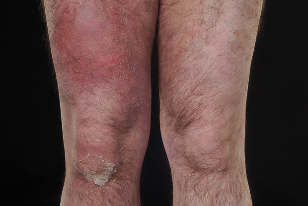 does cellulitis itch