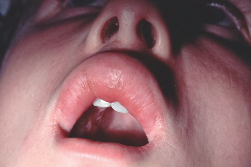 Differential Diagnoses Presentation And Management Of Lip