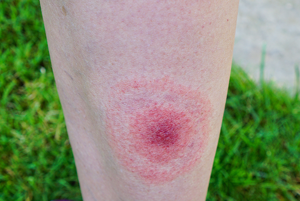 Lyme disease: There is often a characteristic skin rash at the site of the tick bite, known as erythema migrans (Photo: iStock.com/fanakopa)