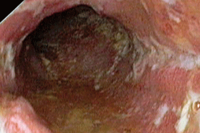 Pictures of anal disease from bad hygiene