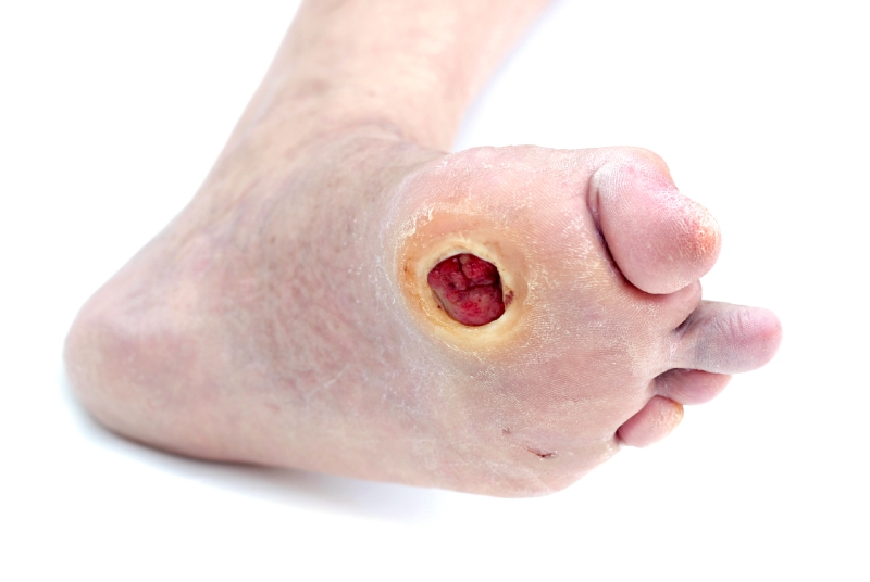 treating foot ulcers