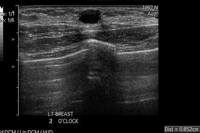 Ultrasound scan showing a simple cyst in the breast (Author images)