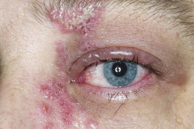 Our clinical review on shingles is the most-read clinical feature (Photograph: SPL)