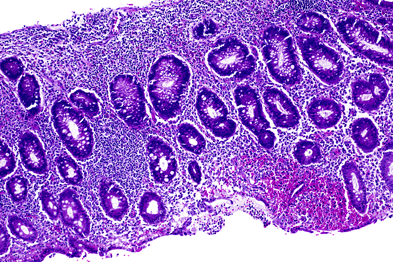 Stool calprotectin testing 'can identify IBD patients' | GPonline