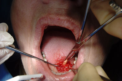 Removing A Stone From A Salivary Duct Gponline