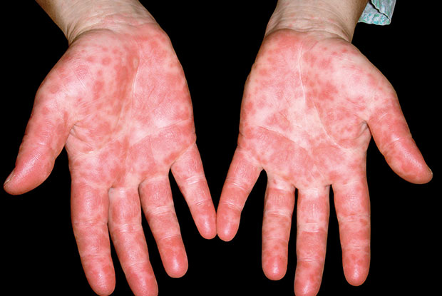 Skin Conditions In Young Children Gponline