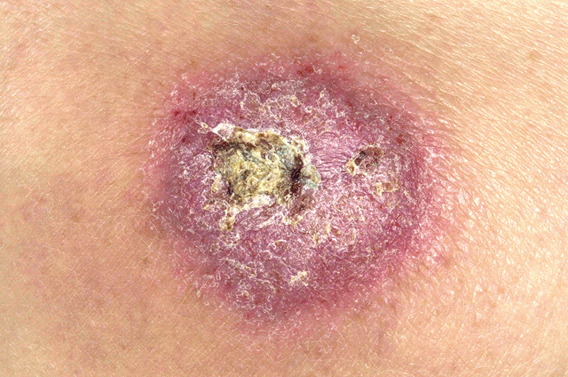 Differential diagnoses: Crusted skin lesions | GPonline