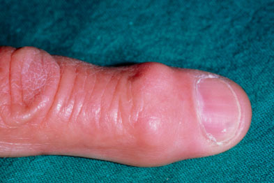 Herberden's nodes on the finger of a patient with osteoarthritis