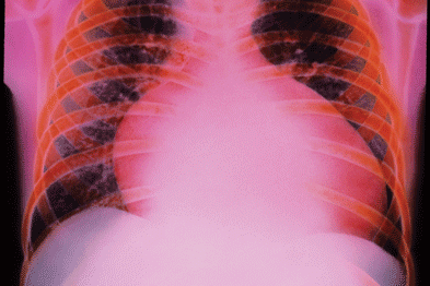 Coloured chest X-ray of a child with cariomyopathy