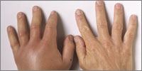 Oedema, erythema and pain at the site of the sting develops over hours and settles within a few days