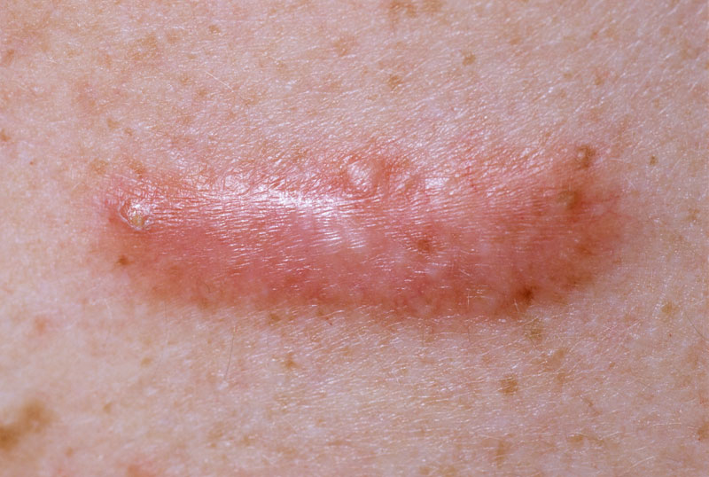 All you need to know about Keloid Scars and how to treat them