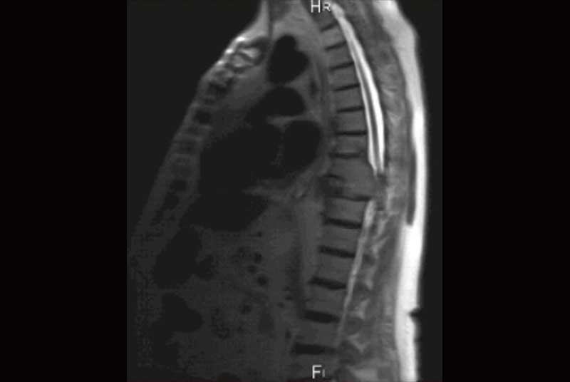 The MRI scan showed infilrated lesion involving T3 and T4 