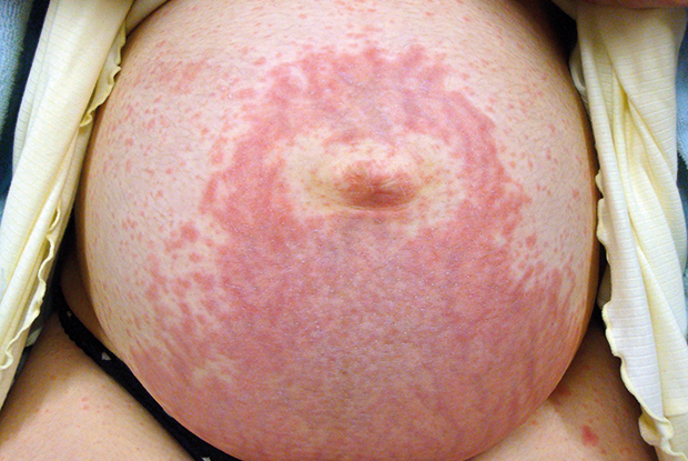 postpartum psoriasis flare up