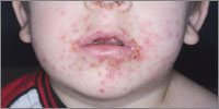 At A Glance Impetigo Versus Eczema Herpeticum Gponline