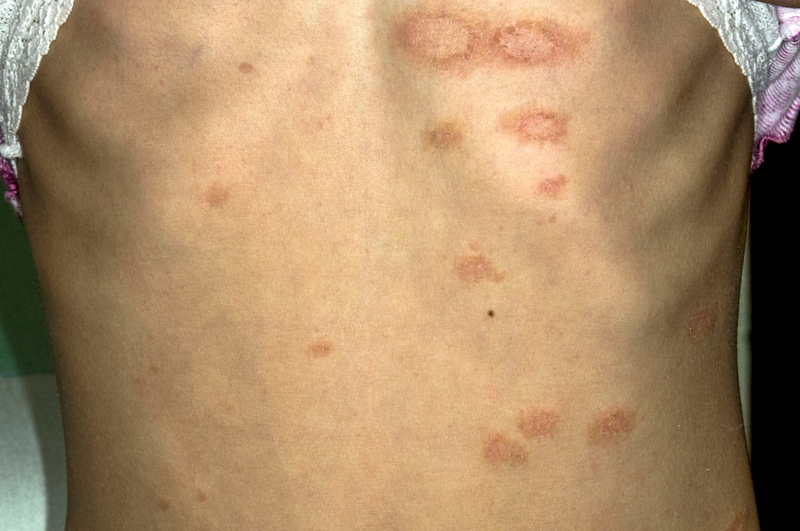 Differential Diagnosis Pityriasis Gponline