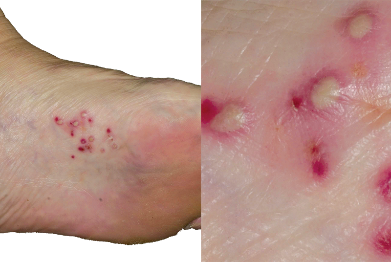 mild pustular psoriasis feet)