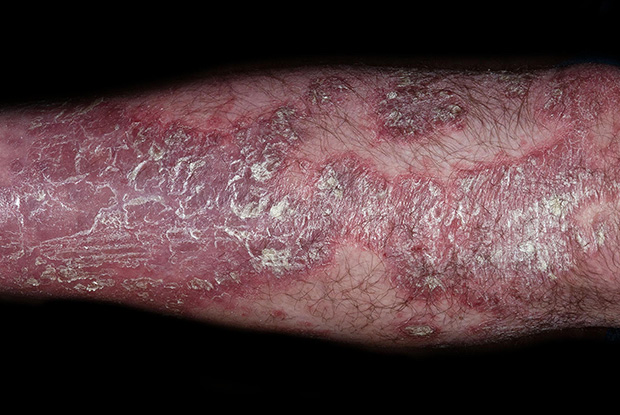 plaque psoriasis nhs vörös pattanásokhoz hasonló foltok az arcon
