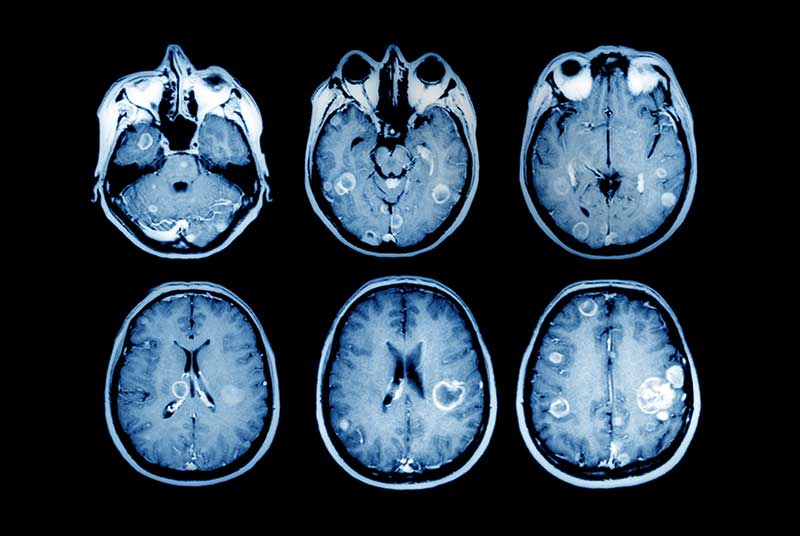 MRI scans showing brain tumours: many CCGs in England are denying GPs direct access (SPL)