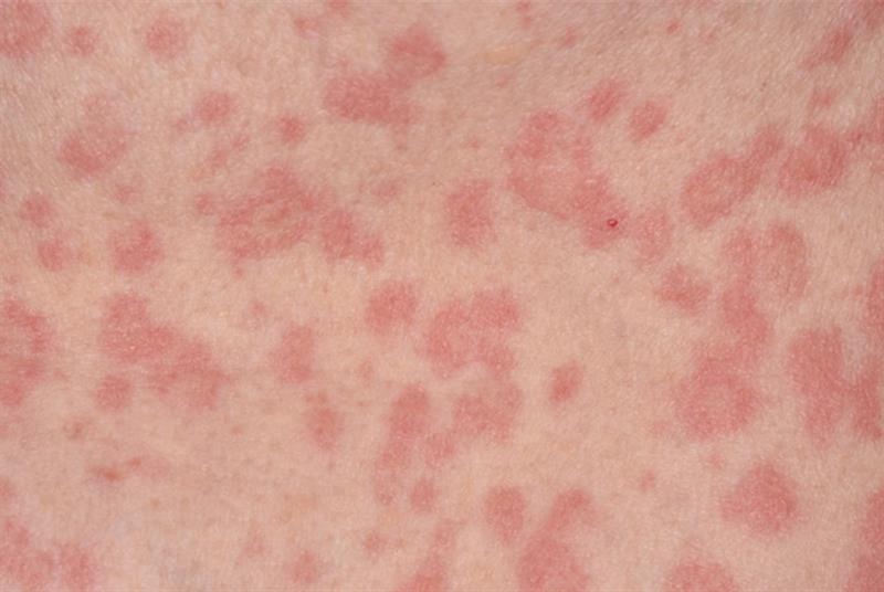 Urticaria rash on the skin of a 61-year-old woman after partial treatment with antihistamine drugs (Photo: Dr P Marazzi/Science Photo Library)