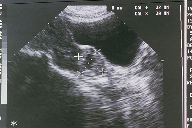 ultrasound ectopic pregnancy symptoms 4 weeks