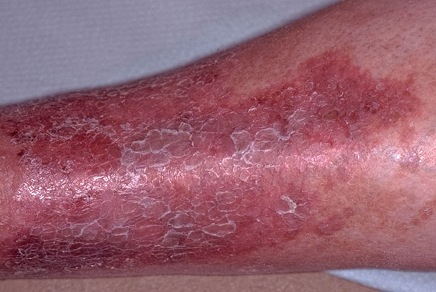 Psoriasis vs ekcéma képek a törzsön