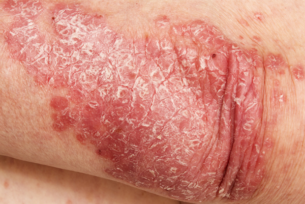 psoriasis treatment uk)