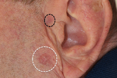 Basal Cell Carcinoma Clinical Review Gponline