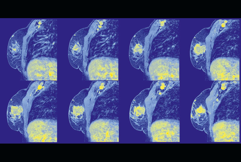Coloured MRI scans of a 58-year old woman's right breast and thorax, showing adenocarcinoma (yellow area in the breast) (SPL)
